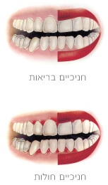 דלקת-חניכיים
